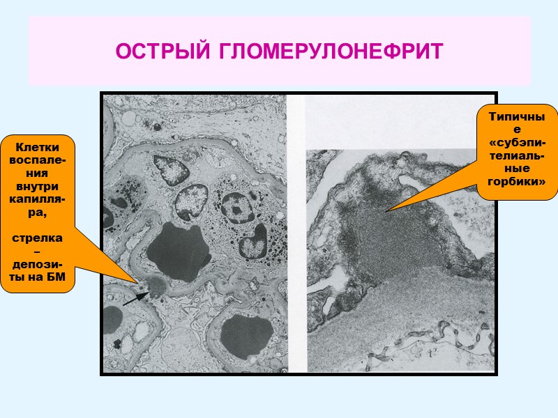 ОСТРЫЙ ГЛОМЕРУЛОНЕФРИТ Типичные «субэпи-телиаль-ные горбики» Клетки воспале-ния внутри капилля-ра,   стрелка – депози-ты